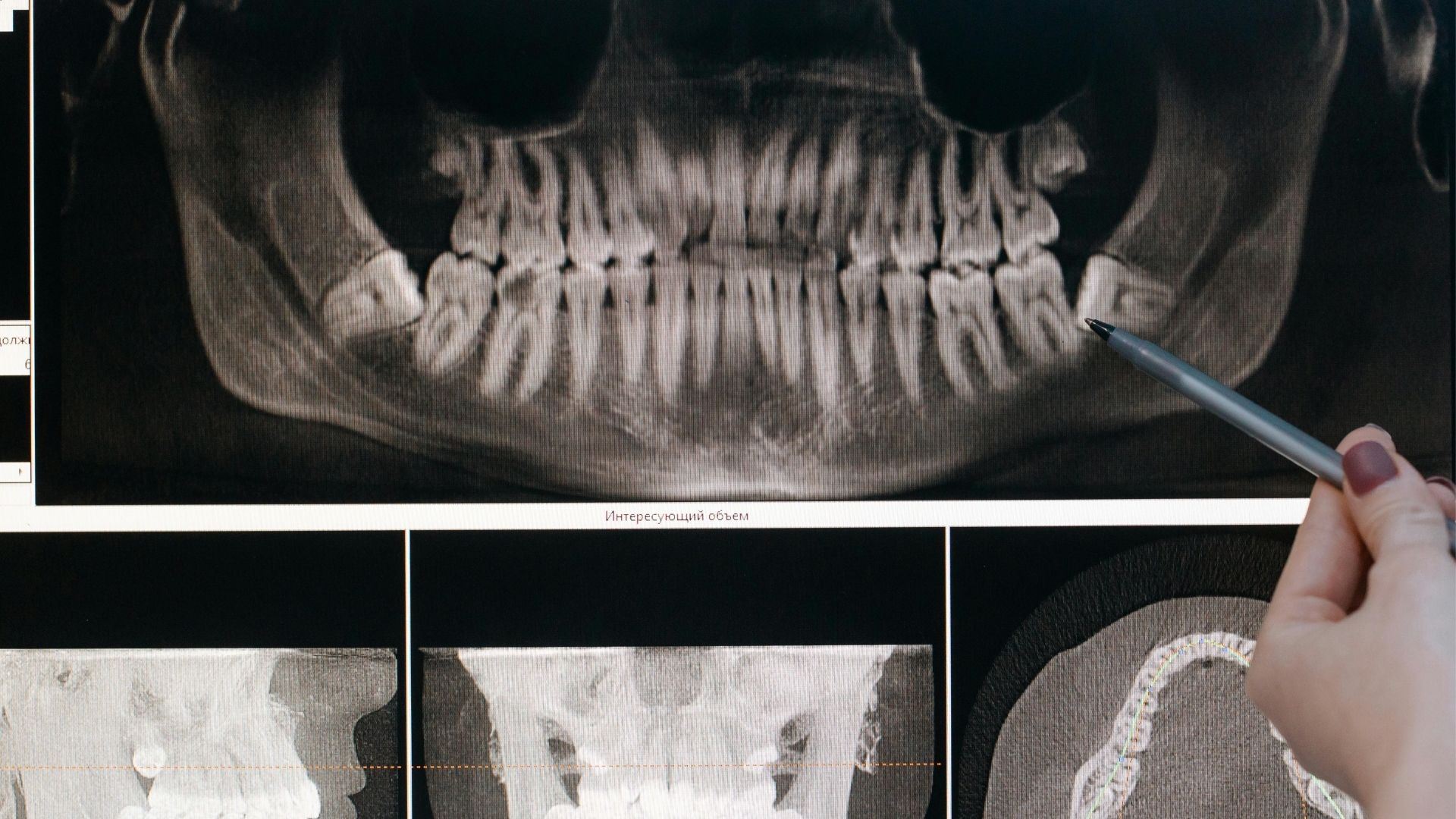 Bölcsességfog műtét a MyDent Fogászatnál